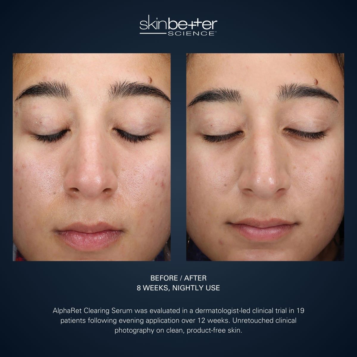 AlphaRet Clearing Serum