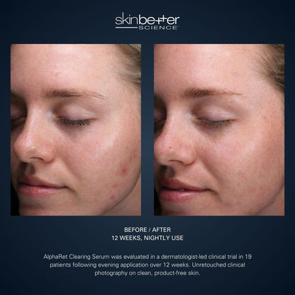 skinbetter science AlphaRet Clearing Serum