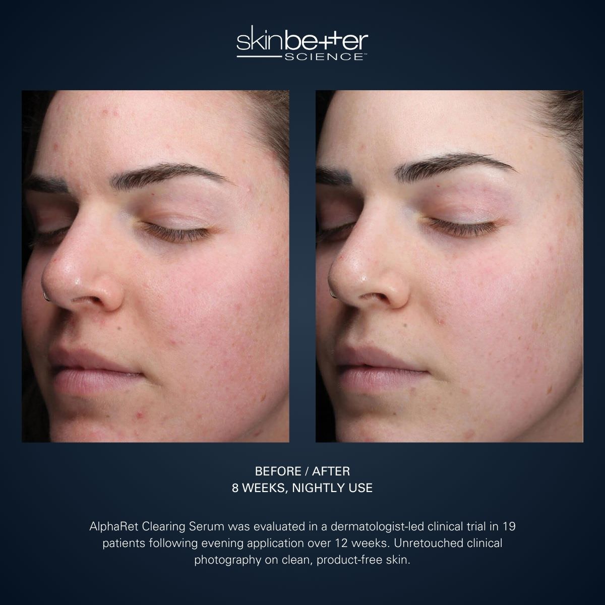 skinbetter science AlphaRet Clearing Serum